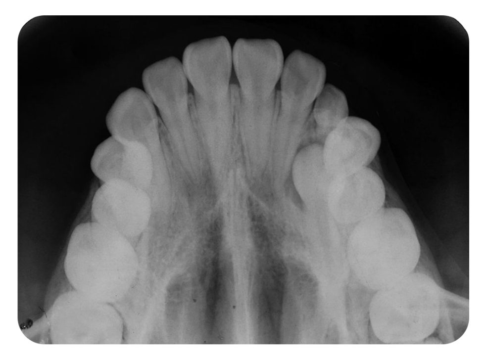 Radiografía oclusal Mi blog